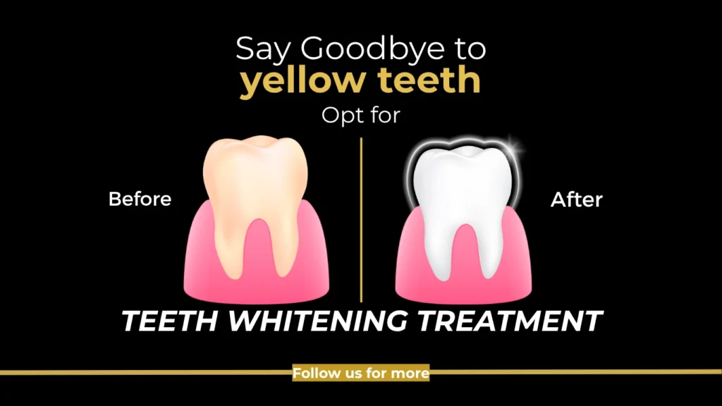 Say Goodbye to Yellow Teeth with Professional Teeth Whitening